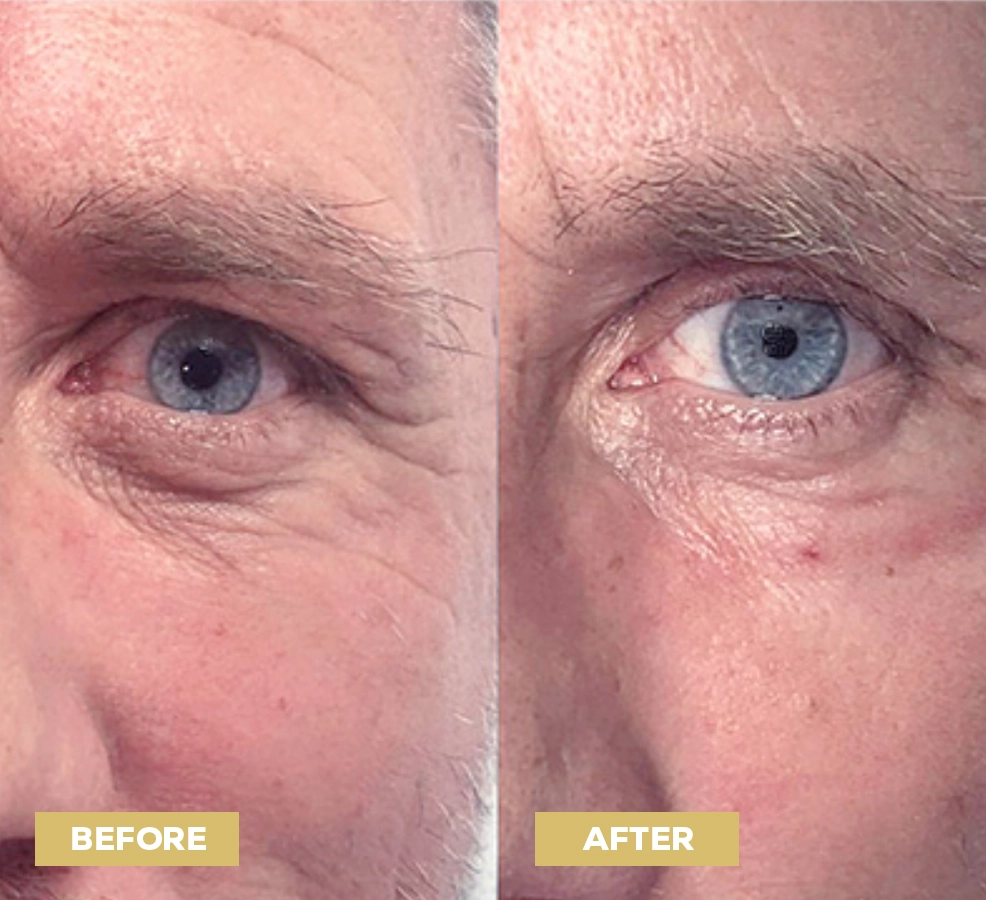 Nucleofill Before and After