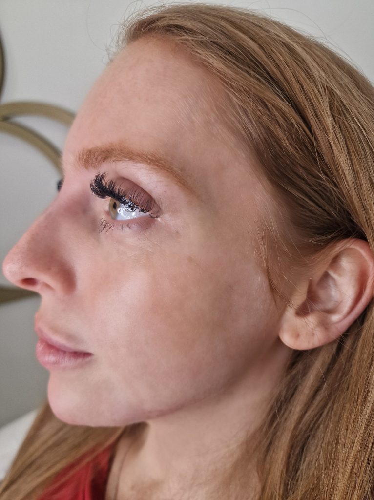 After Jaw Filler
