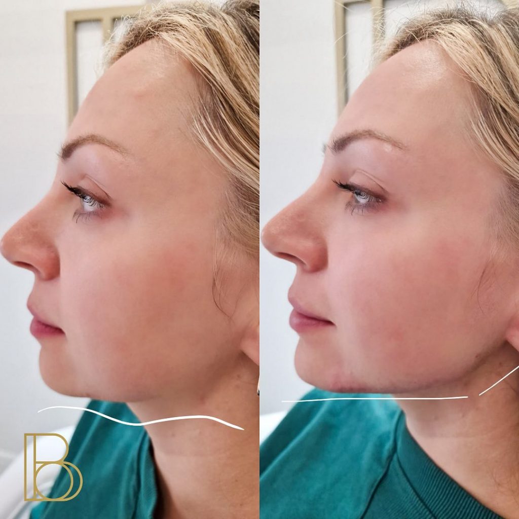 Jaw Filler before and after