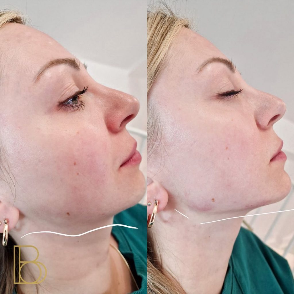 Jaw Filler before and after