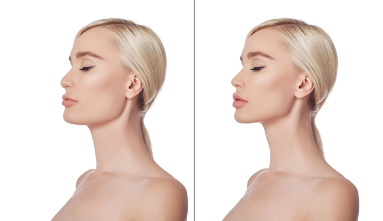Jaw Fillers