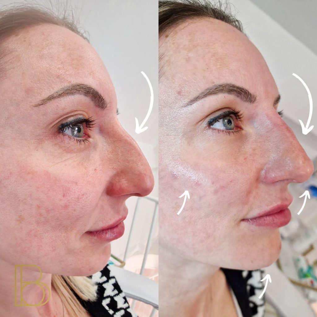 Nose Filler Results