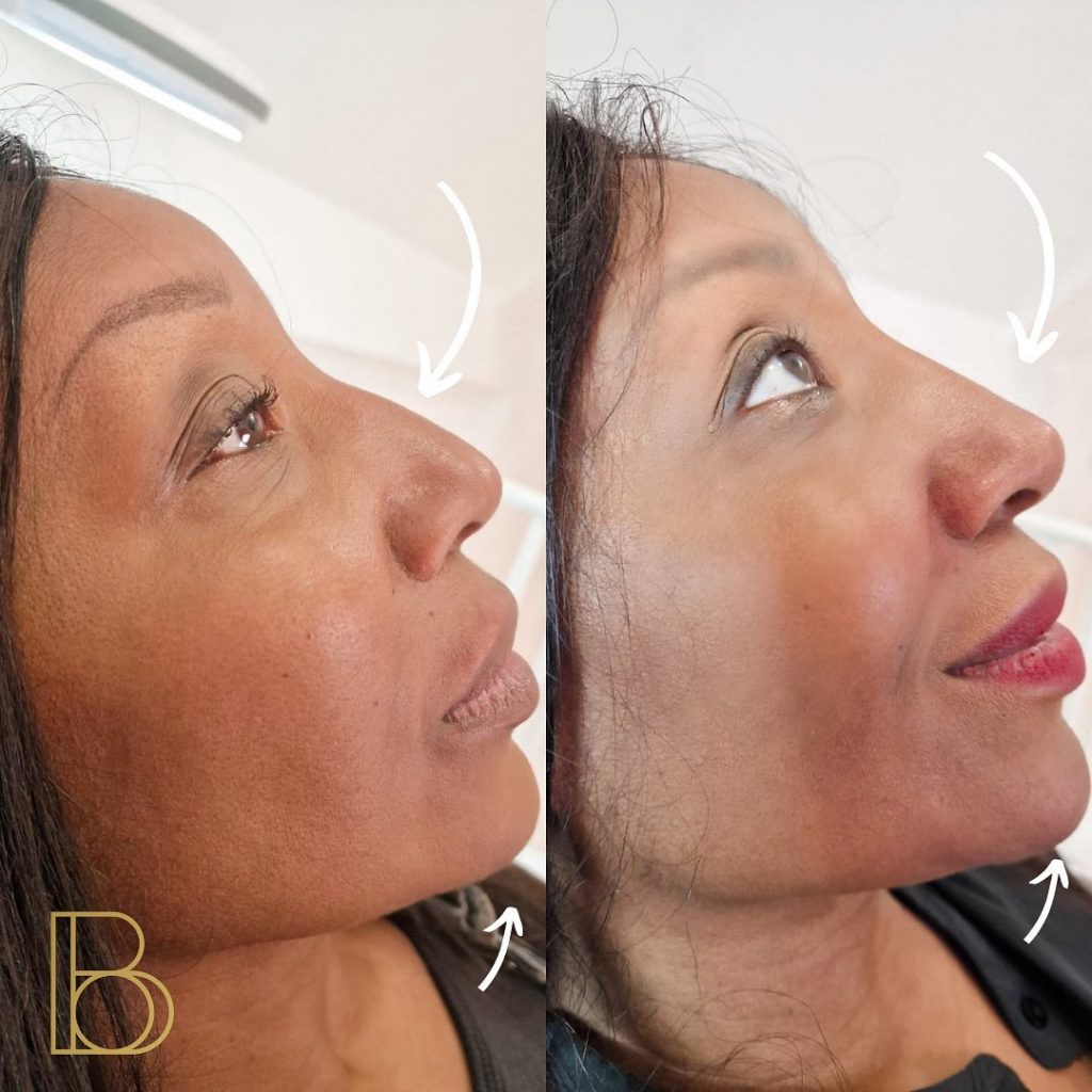 Nose Filler Results