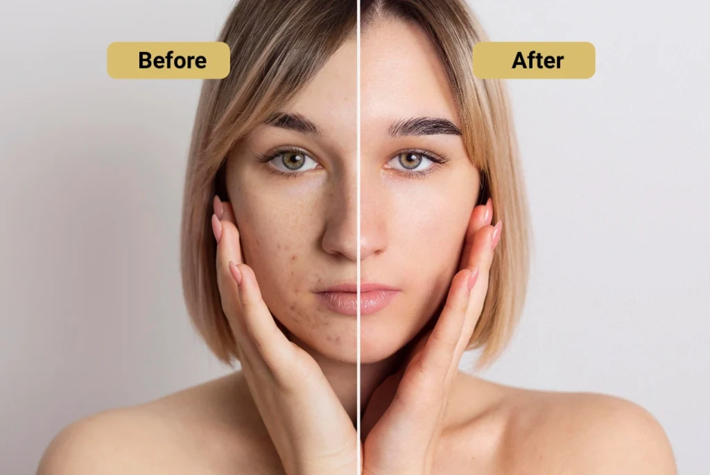 Exosome Therapy before and after