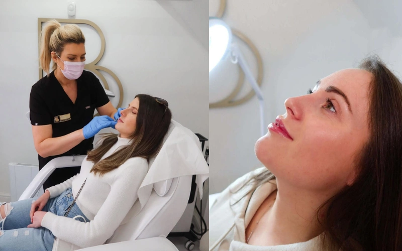 first time getting dermal fillers