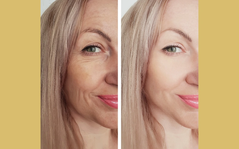 Realistic Results & Local Experience of anti wrinkle treatments