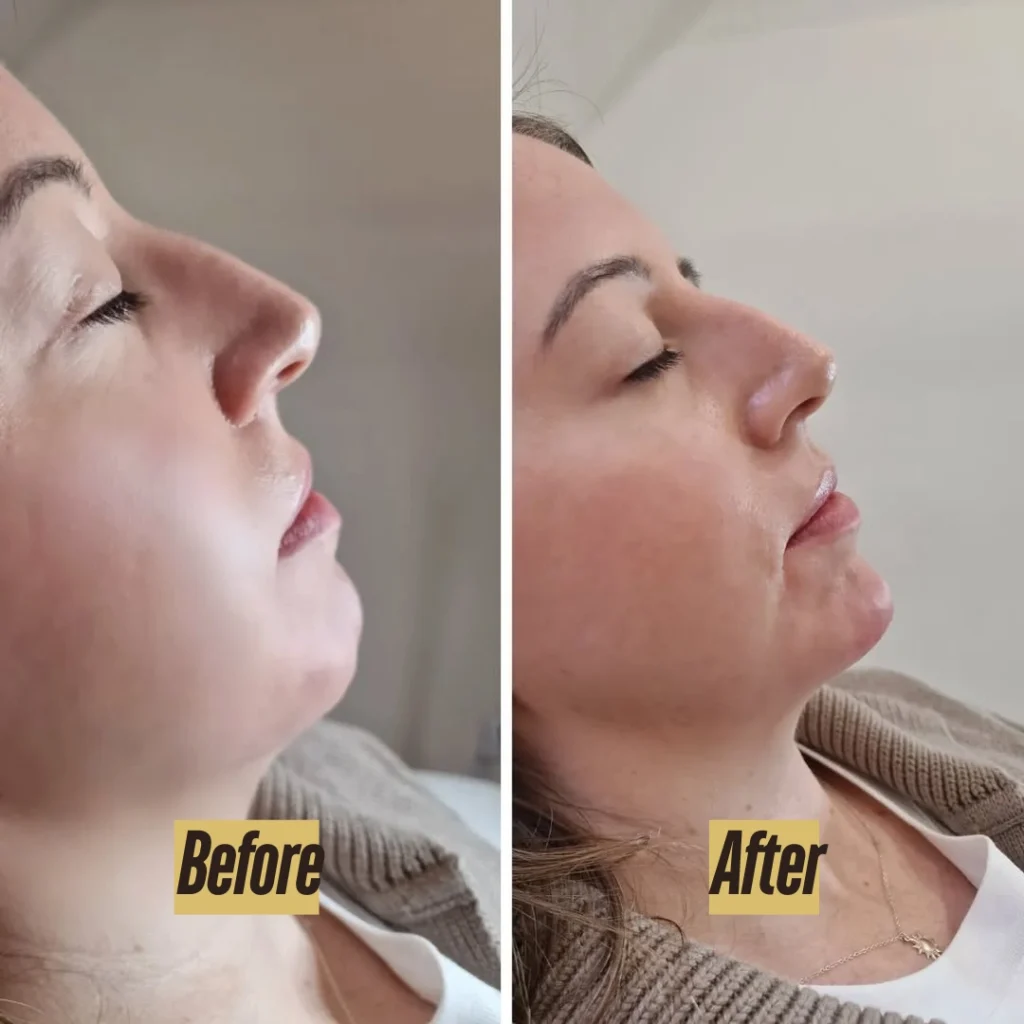 Before and after jawline dermal filler results at Bare Brilliance in Windsor